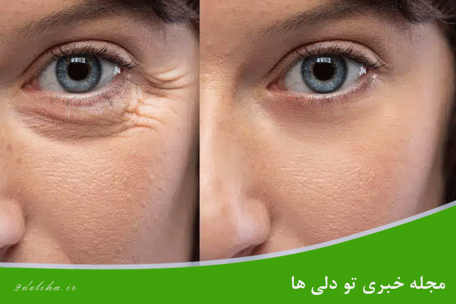 چروک دور چشم؛ از دلایل ایجاد تا بهترین روش‌های بهبود